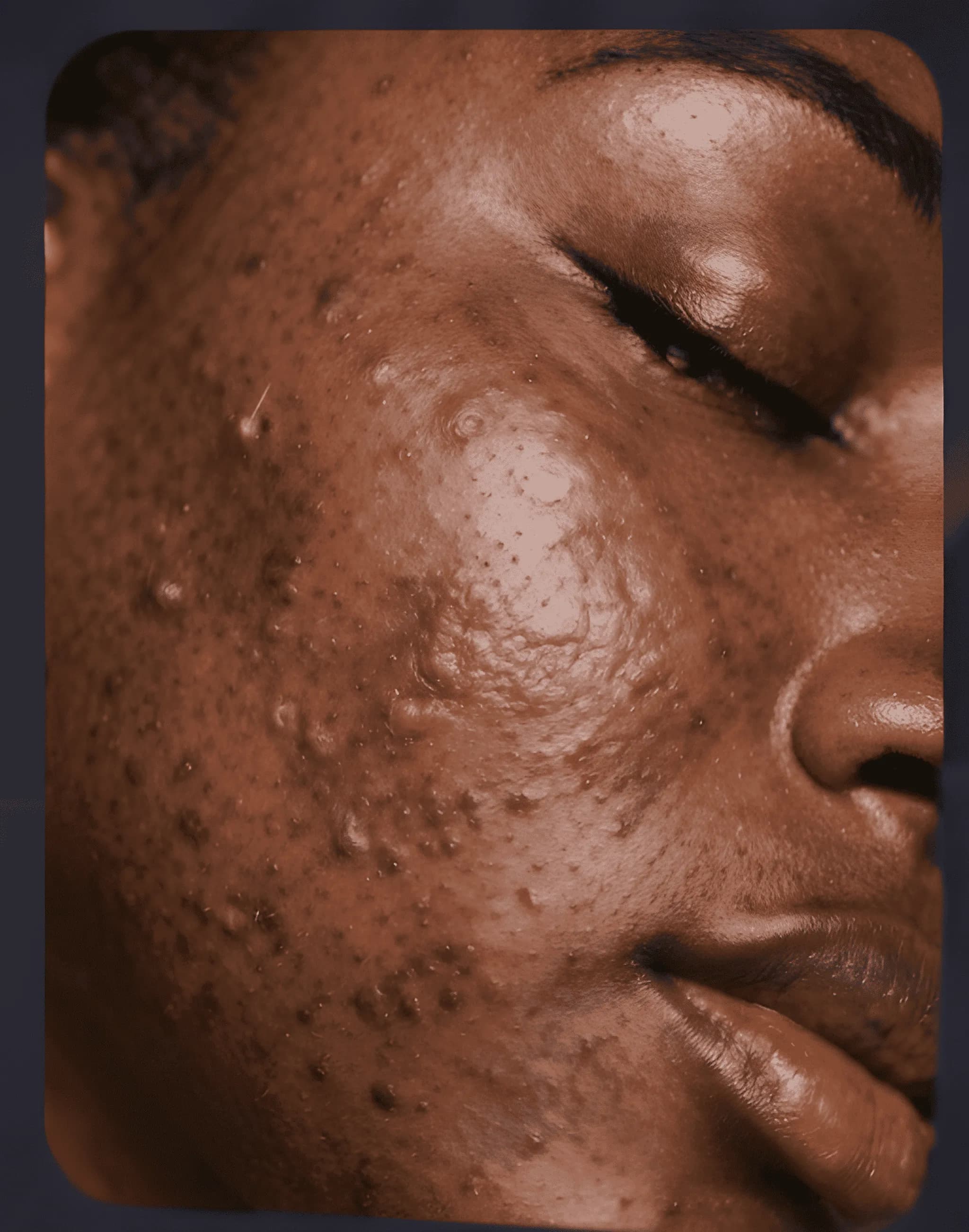 Avant le soin — peau avec imperfections
